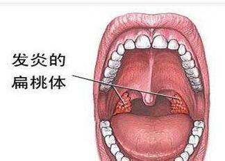 扁桃體(tǐ)發炎要一刀切嗎(ma)